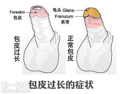 包茎引起早泄怎么办 推荐三种简单方法