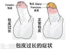 包茎对早泄有影响吗 分享一个真实案列