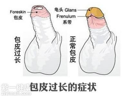 包茎对早泄有影响吗 分享一个真实案列