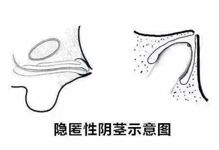 科普:肥胖的男人，“丁丁”为什么会缩小 ?