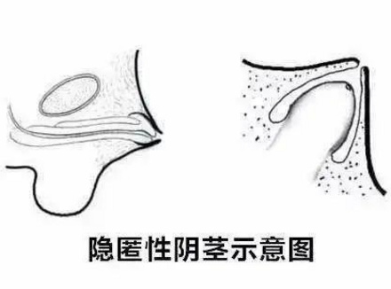 科普:肥胖的男人，“丁丁”为什么会缩小 ?
