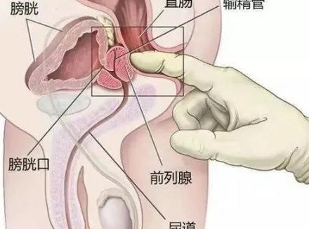 前列腺高潮一般激活要多久