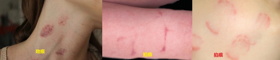 如何正确辨别掐痕和吻痕？附对比图片
