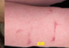 如何正确辨别掐痕和吻痕？附对比图片