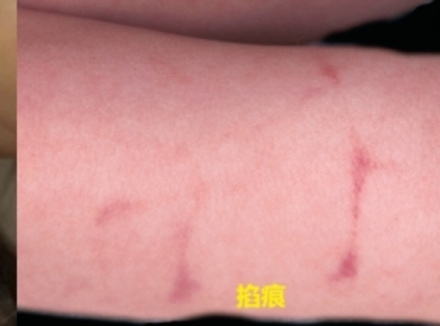 如何正确辨别掐痕和吻痕？附对比图片