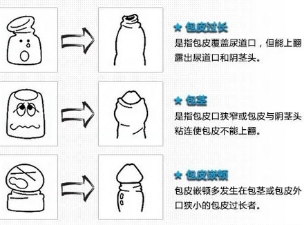 龟头敏感怎么办 4个方法增加龟头敏感度