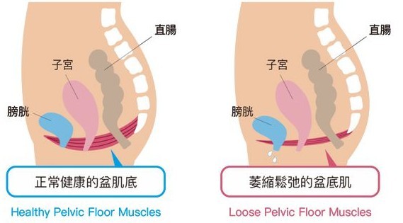 松弛怎么变紧致？女人都应该了解的凯格尔运动！