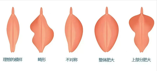 小阴唇一边大一边小，是正常现象吗