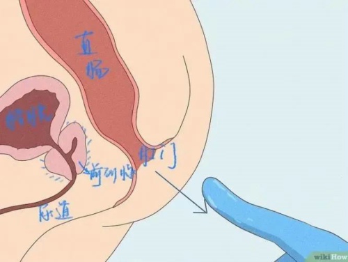 前列腺液是怎样取出来的